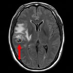 No.’25_100　手術前1