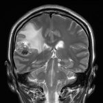 No.’25_100　手術前2