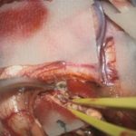 No.’25_100　 摘出 中