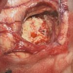 No.’25_100　摘出 後