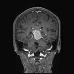 No.’25_109　手術前2