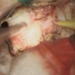 No.’25_109　 摘出 中