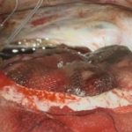 No.’25_109　摘出 後