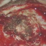 No.’25_104　摘出 前