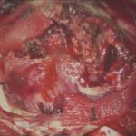 No.’25_104　 摘出 中