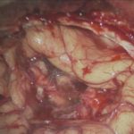 No.’25_104　摘出 後