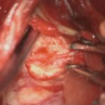 No.’25_103　摘出 前