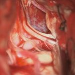 No.’25_103　 摘出 中