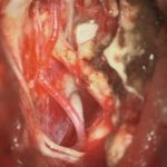 No.’25_103　摘出 後