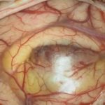 No.’25_106　摘出 前