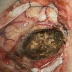 No.’25_106　摘出 後