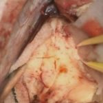 No.’26_9　摘出 前