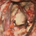 No.’26_9　摘出 後