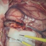 No.’25_116　摘出 前