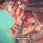 No.’25_116　 摘出 中