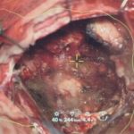 No.’25_116　摘出 後