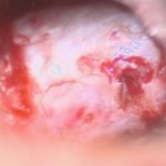 No.’26_2　摘出 前