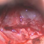 No.’26_2　 摘出 中