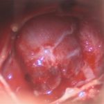 No.’26_2　摘出 後