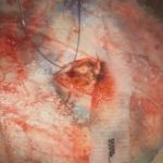 No.’25_115　摘出 前