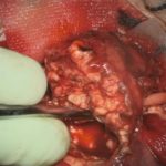 No.’25_115　 摘出 中