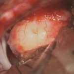 No.’26_14　摘出 前