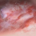 No.’26_7　摘出 前