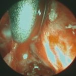 No.’26_7　 摘出 中