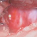 No.’26_7　摘出 後