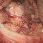 No.’26_8　摘出 後