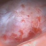 No.’26_15　摘出 前