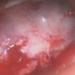 No.’26_15　 摘出 中