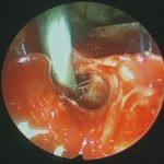 No.’26_15　摘出 後