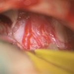 No.’26_6　摘出 前