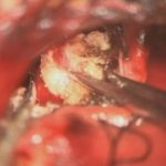 No.’26_6　 摘出 中