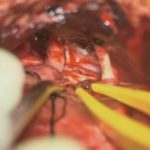 No.’26_6　摘出 後