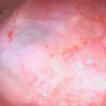 No.’26_10　摘出 前