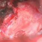 No.’26_10　 摘出 中