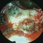 No.’26_10　摘出 後