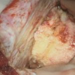 No.’26_16　摘出 前