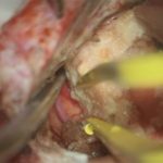 No.’26_16　 摘出 中