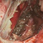 No.’26_16　摘出 後