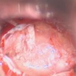 No.’26_20　摘出 前