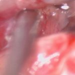 No.’26_20　 摘出 中