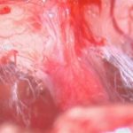 No.’26_20　摘出 後