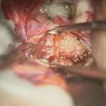 No.’26_22　摘出 前