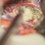 No.’26_22　 摘出 中