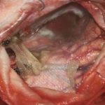 No.’26_22　摘出 後