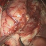 No.’26_18　摘出 前