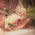 No.’26_18　 摘出 中